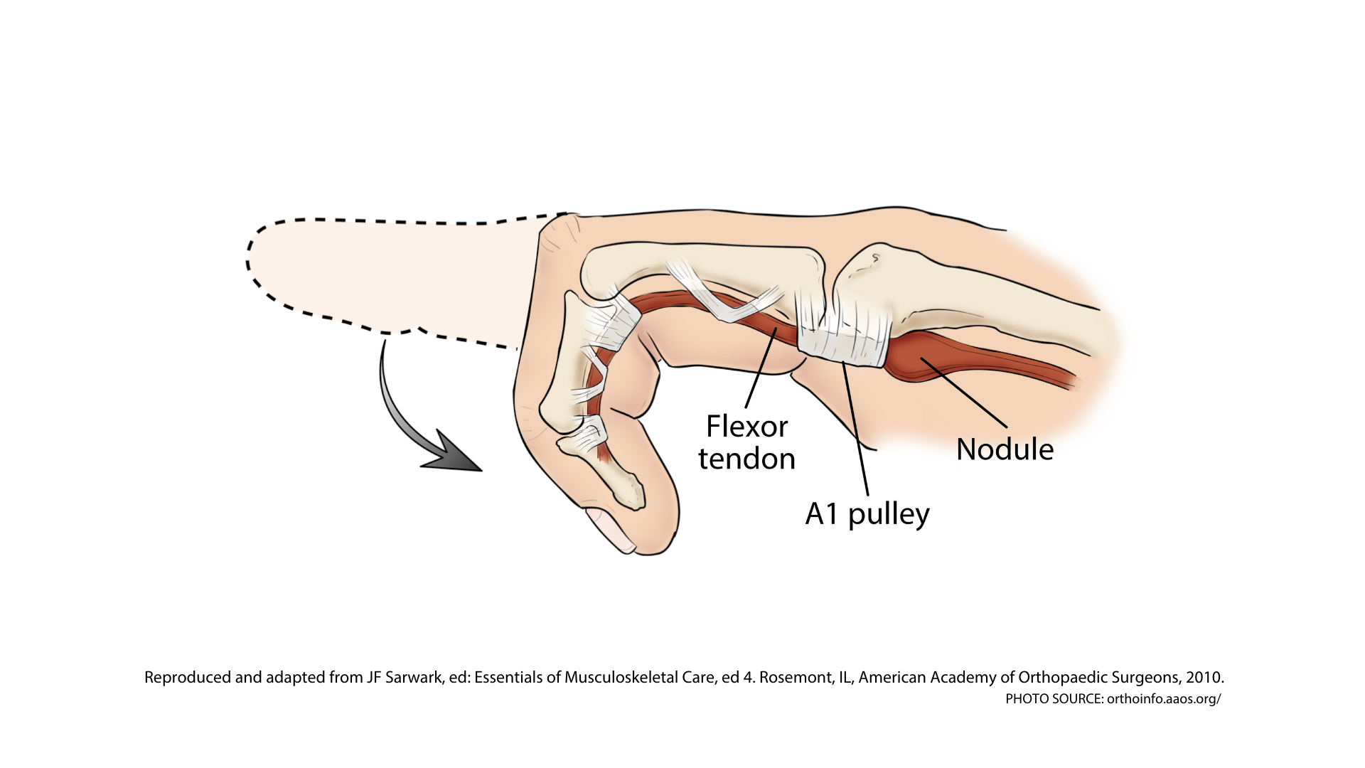 Read more about the article Trigger Finger…Are You At Risk?